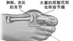 【生態(tài)科普】301醫(yī)院：氫水對(duì)高尿酸血癥有療效