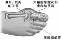 氫水對(duì)高尿酸血癥有療效