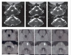 富氫水減輕腦缺血再灌注損傷后神經(jīng)細胞自噬性死亡的研究