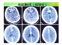 miR-21在氫氣保護創(chuàng)傷性腦損傷中作用機制研究