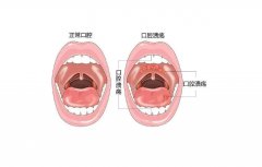 富氫水緩解5-FU誘導(dǎo)的口腔粘膜潰瘍