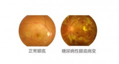 基于中醫(yī)體質(zhì)的2型糖尿病視網(wǎng)膜病變的氫分子醫(yī)學(xué)探討