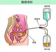 分子氫對腹膜透析患者的臨床研究