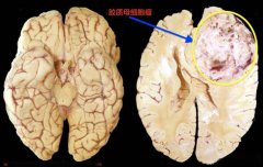 高濃度分子氫：一種潛在的膠質瘤克星
