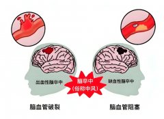 氫氣：為中風(fēng)患者帶來新希望的神奇氣體