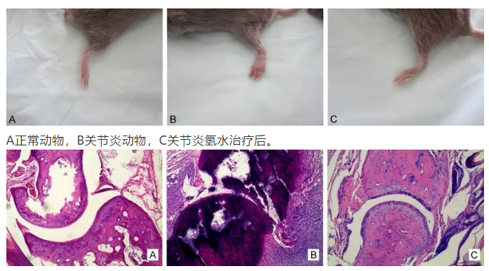 氫水改善類風濕關節(jié)炎的研究
