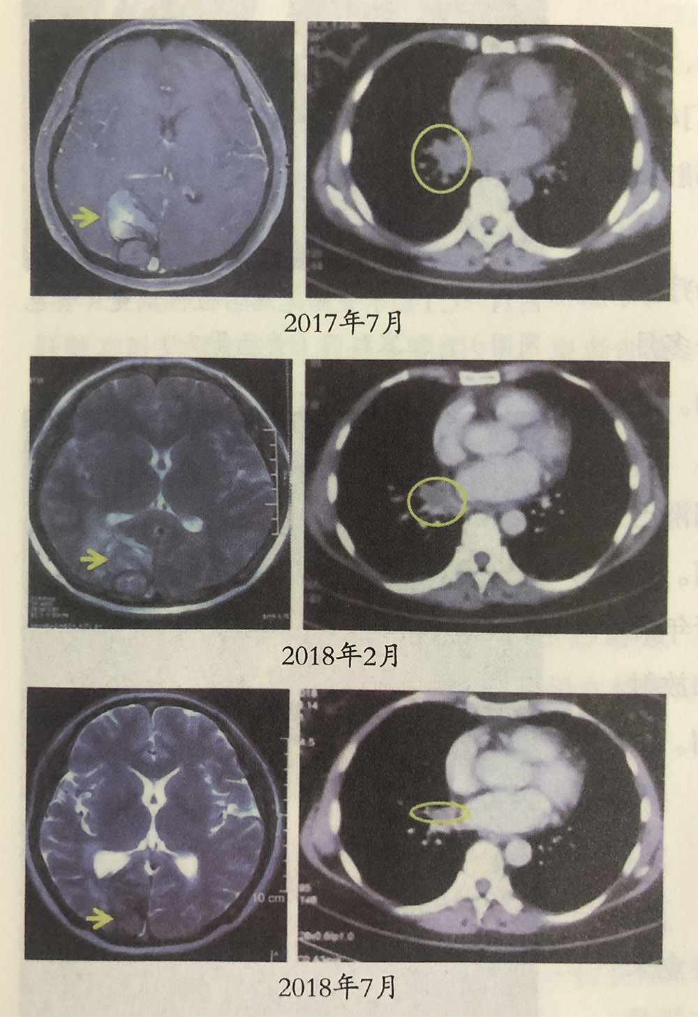 非小細(xì)胞性肺癌伴腦轉(zhuǎn)移