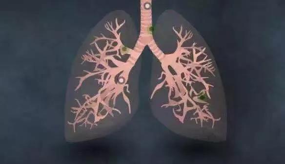 氫案例|肺癌患者家屬的陪護日記：吸氫是應對預后的有效手段