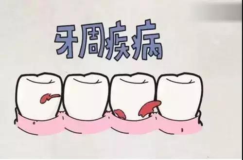 富氫水對(duì)牙齦氧化應(yīng)激和牙槽骨吸收的預(yù)防作用