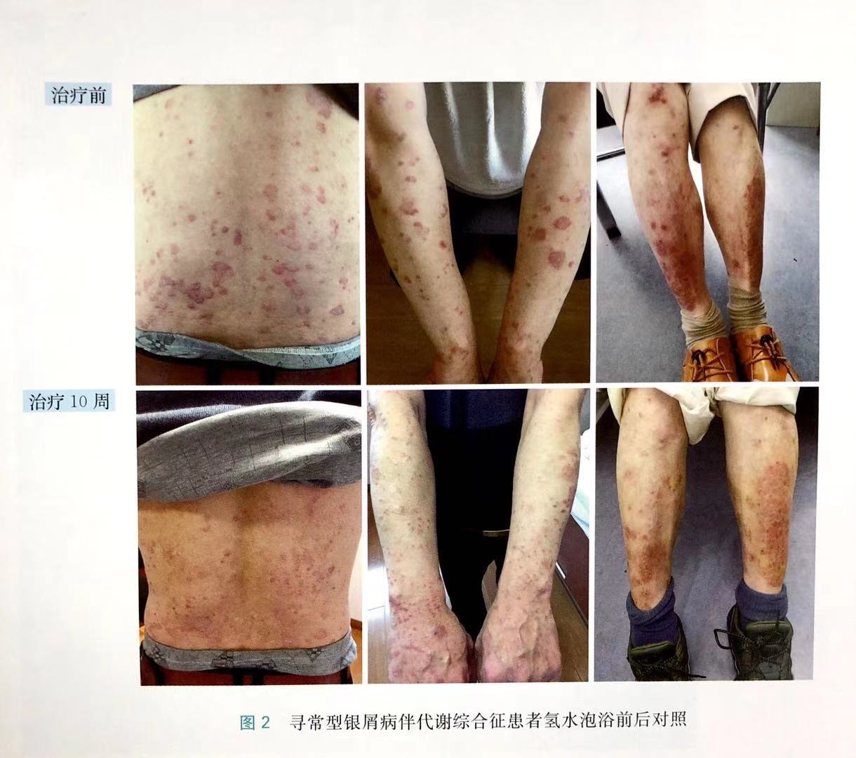 尋常型銀屑病伴代謝綜合征病例