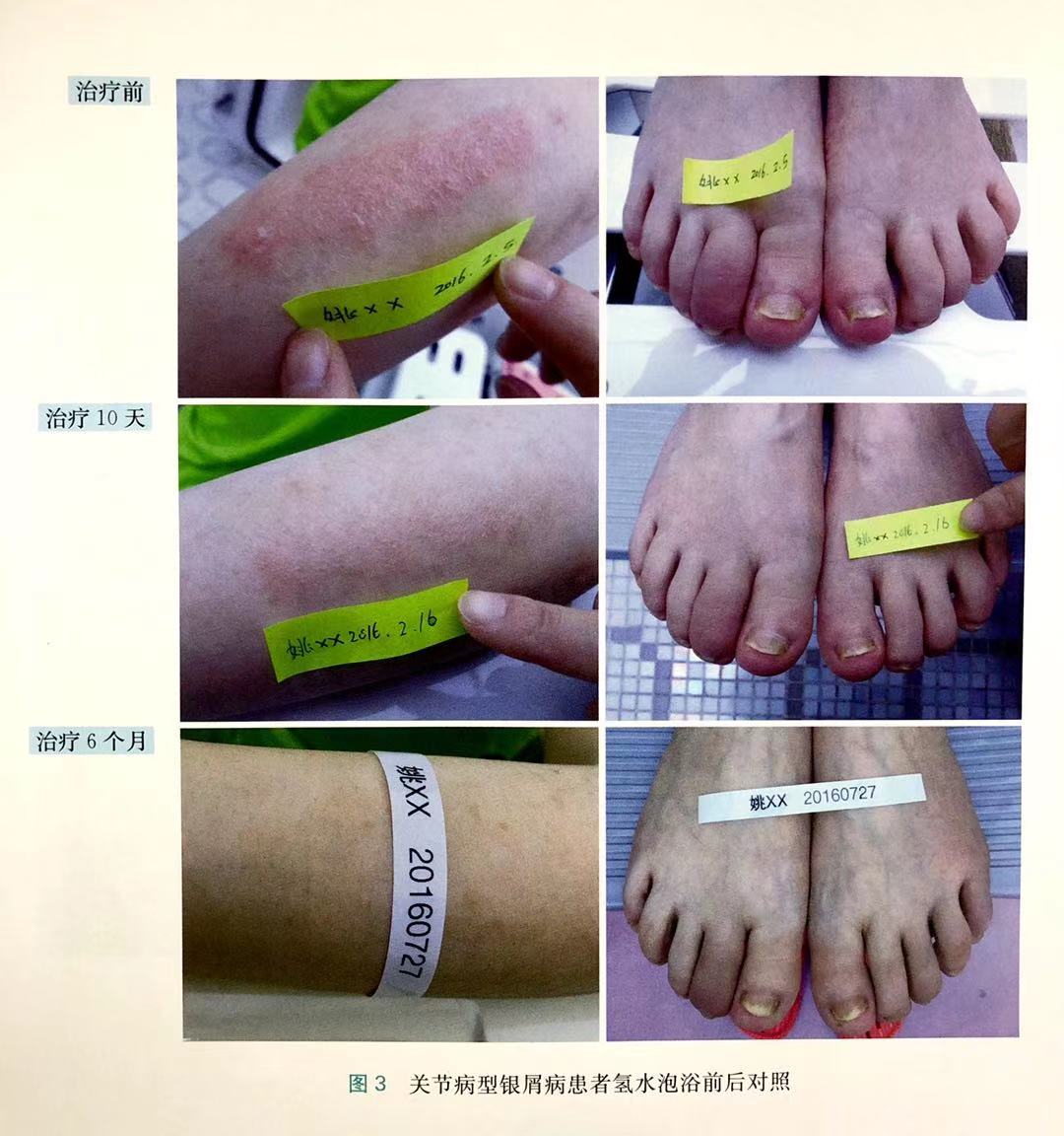 關(guān)節(jié)病型銀屑病案例分享