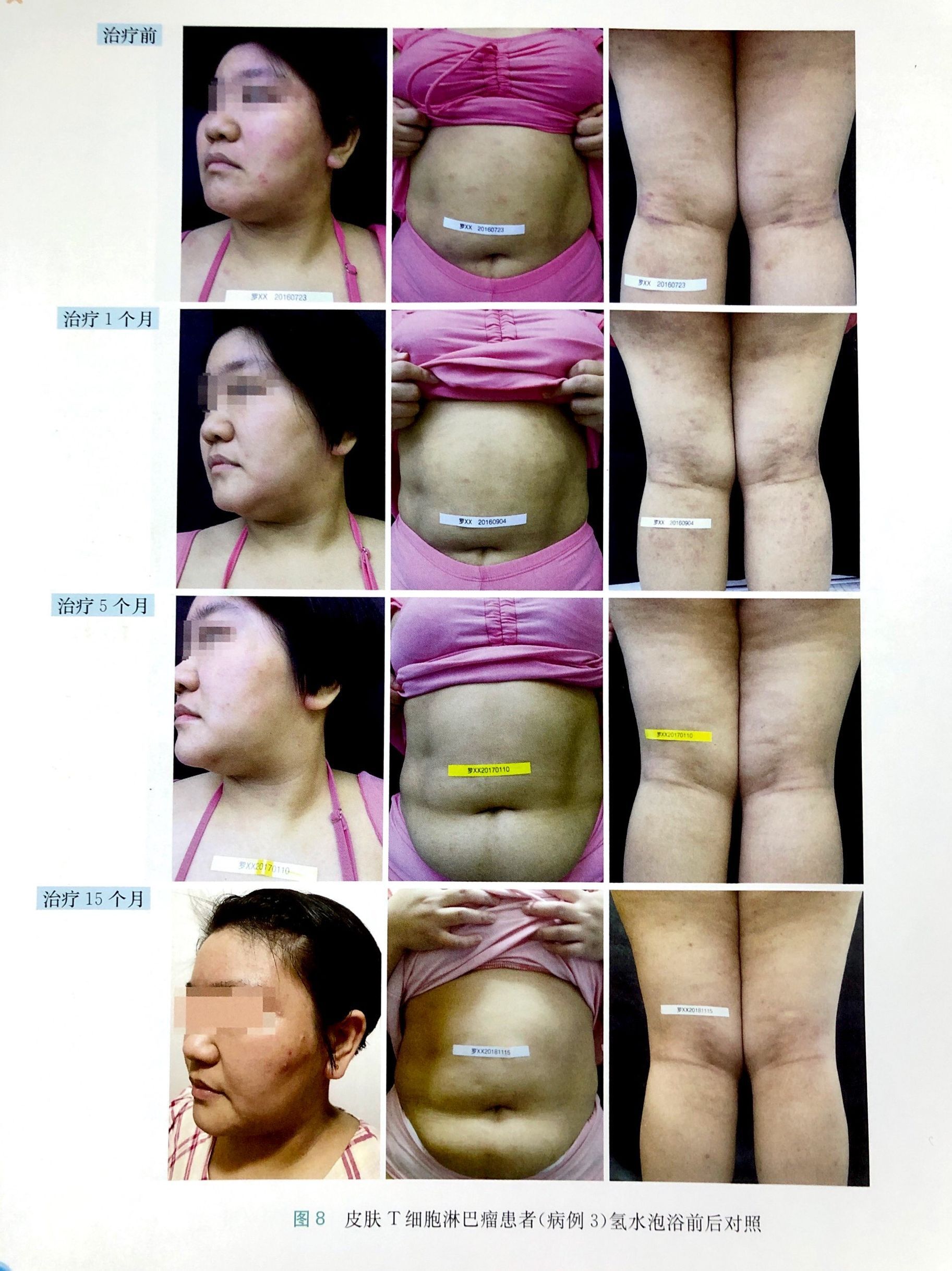  皮膚T細(xì)胞淋巴瘤改善病例三（蕈樣肉芽腫）