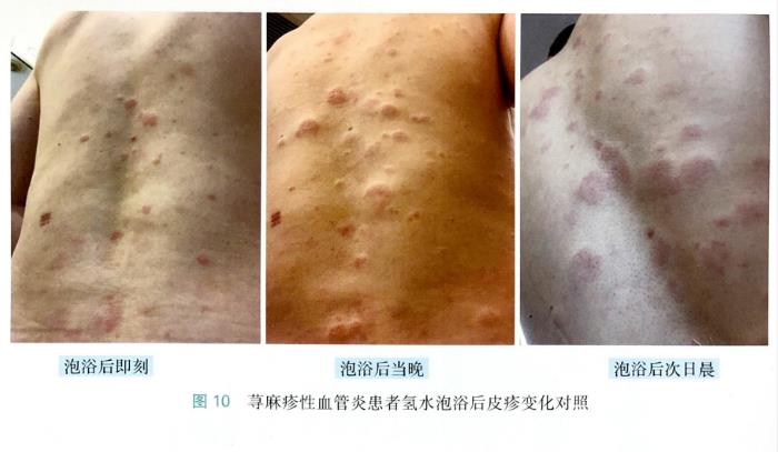 蕁麻疹性血管炎的改善病例