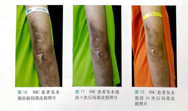 系統(tǒng)性硬化癥的改善病例