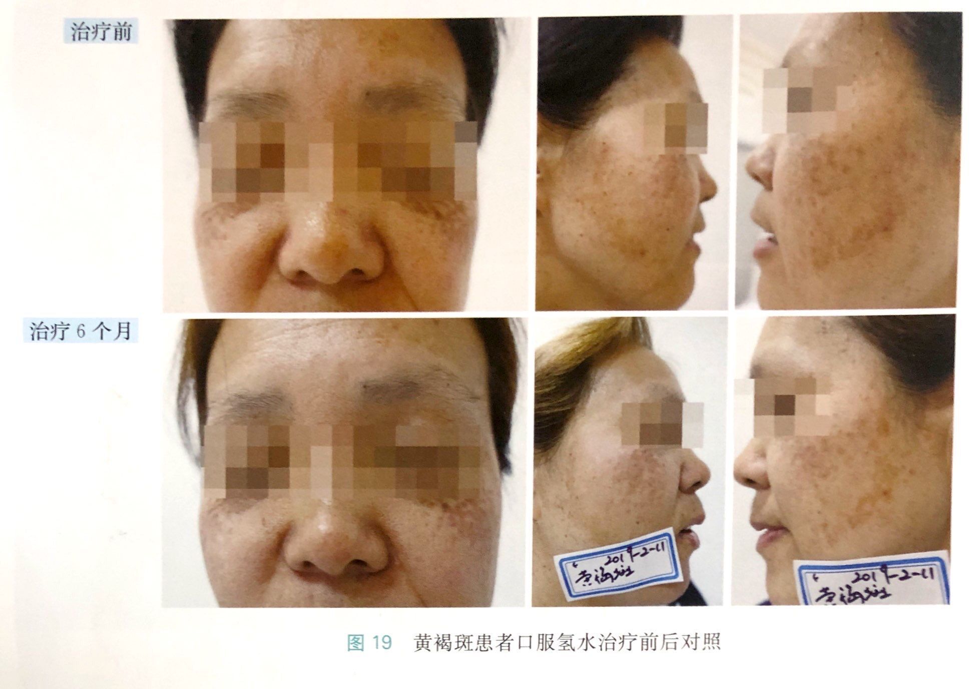 富氫水對黃褐斑的改善病例