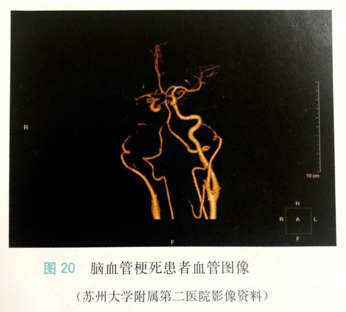 氫氣適用于腦梗死神經(jīng)功能缺損及卒中后抑郁