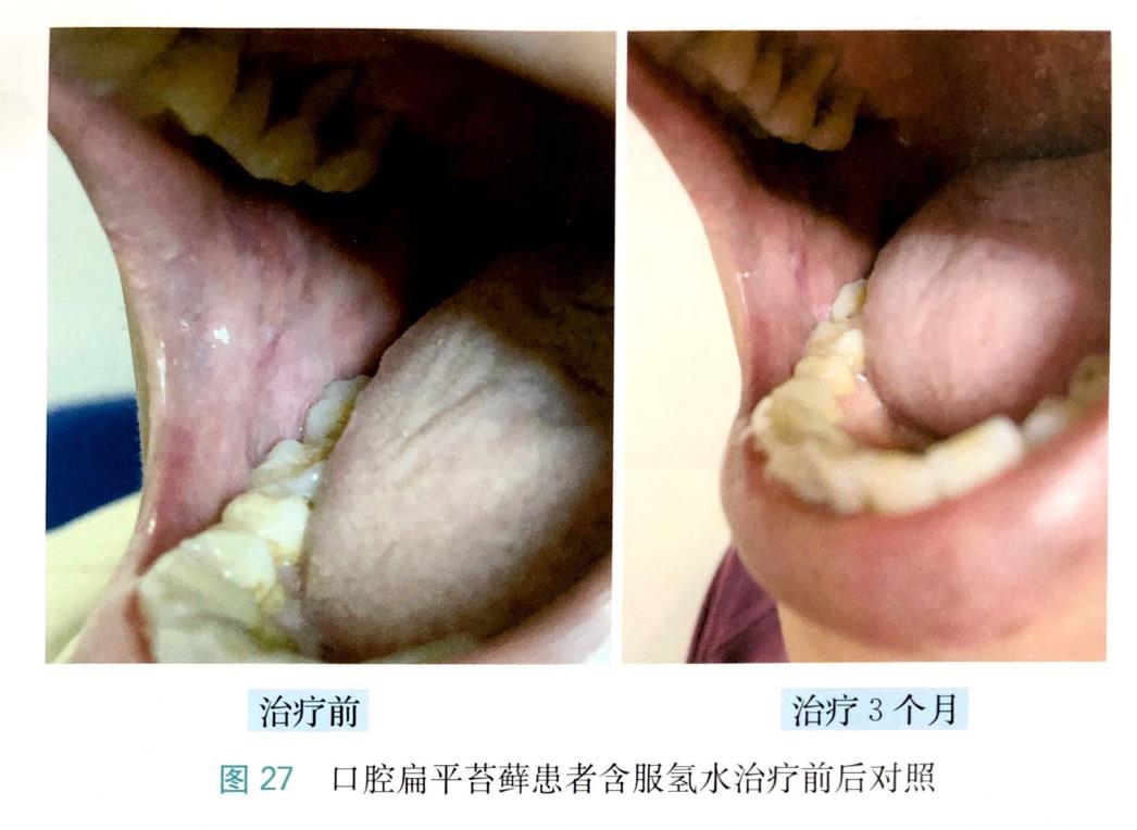 富氫水改善口腔扁平苔蘚的病例