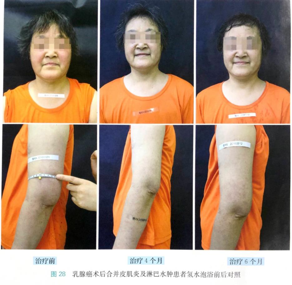 氫氣泡浴改善乳腺癌術(shù)后合并皮肌炎及淋巴水腫