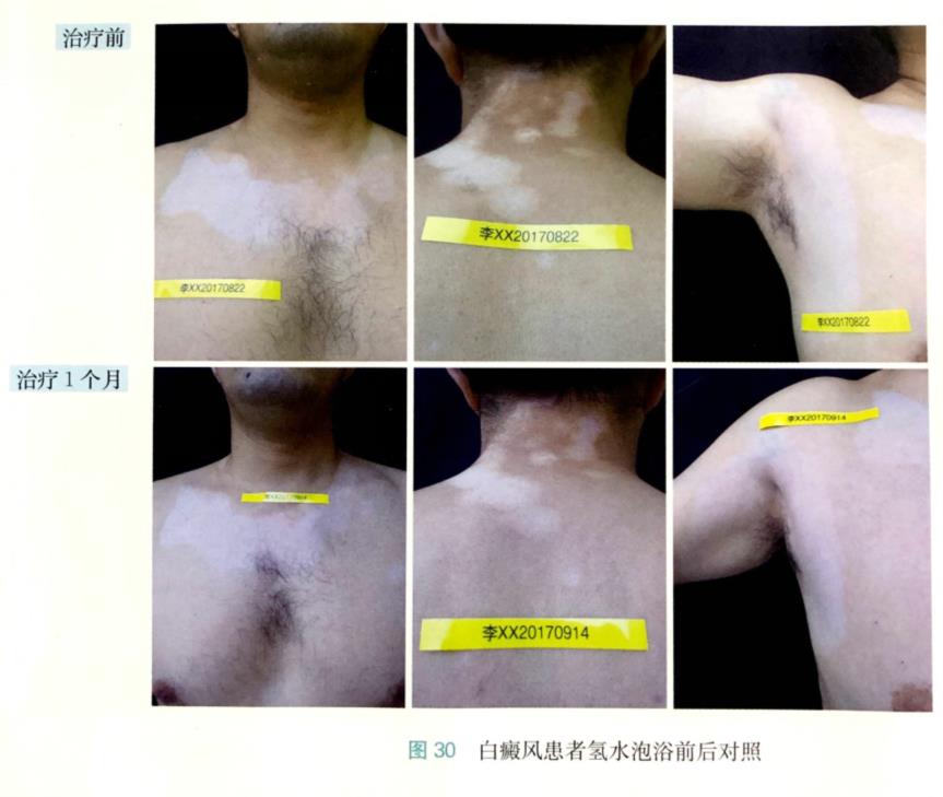 氫氣水泡浴改善白瘢風(fēng)病例