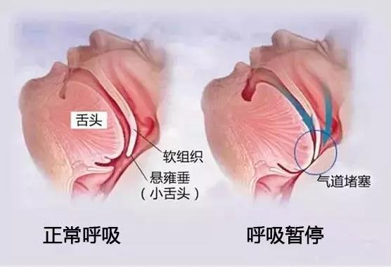 打呼嚕是??！可以用氫氣改善看看