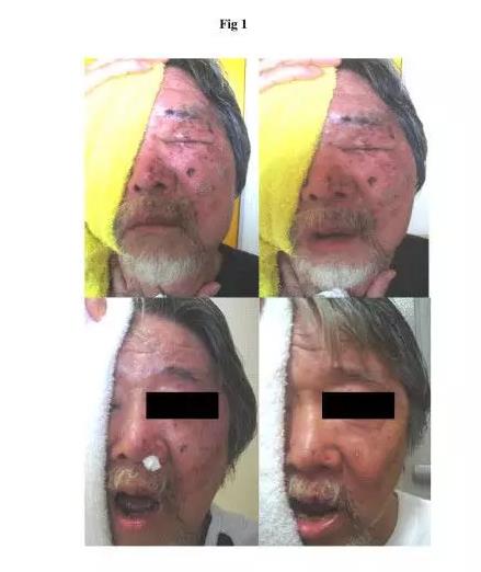 氫水改善皮膚病案例報道