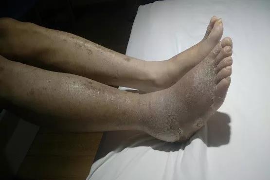 厲害了，我的氫！糖足都可以改善