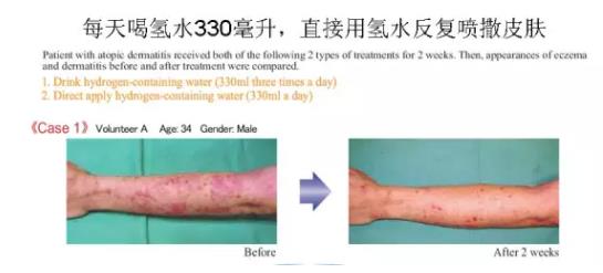 氫氣改善疾病真那么牛嗎？