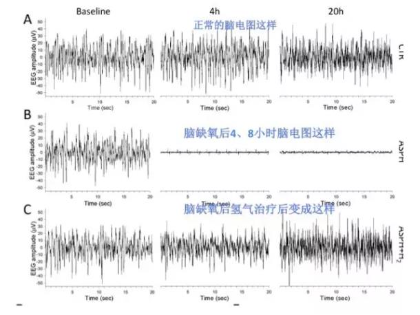 匈牙利：氫氣適用于缺氧腦損傷的神奇作用