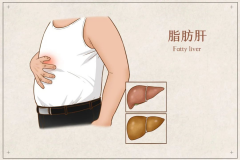 中度脂肪肝，喝氫水可以調(diào)理嗎？