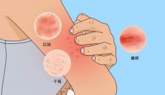 氫醫(yī)學(xué)在皮膚疾病和皮膚美容醫(yī)學(xué)中的應(yīng)用