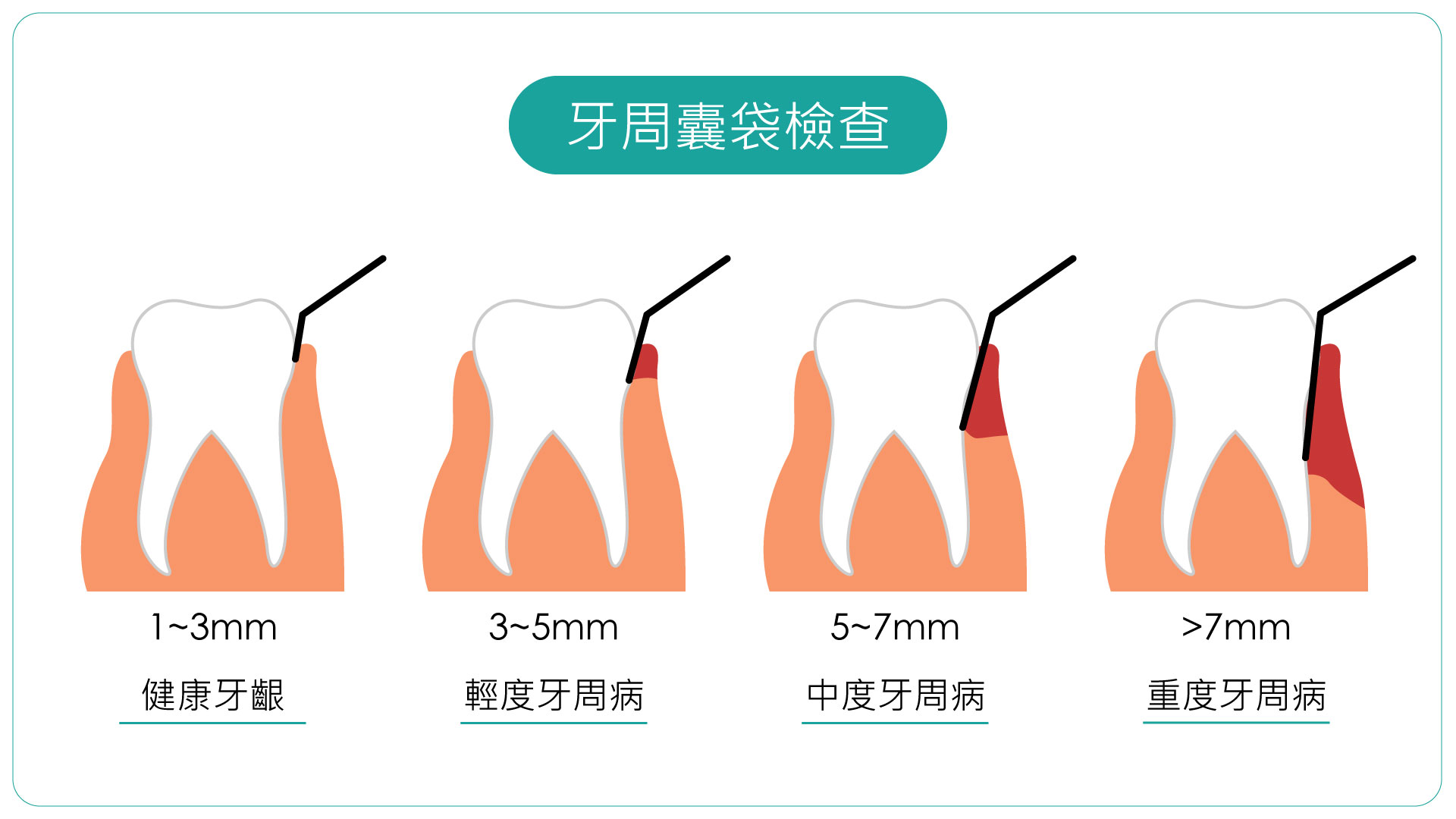 牙周囊是牙周病常見(jiàn)的徵狀，氫氣能有效減緩此癥狀。