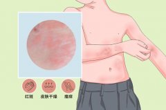 氫醫(yī)學(xué)對(duì)皮膚疾病的應(yīng)用和作用