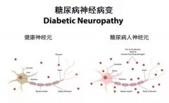 氫對糖尿病周圍神經(jīng)病變具有顯著的保護作用