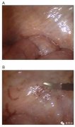 氫氣對(duì)腹膜透析包裹性腹膜硬化癥的案例